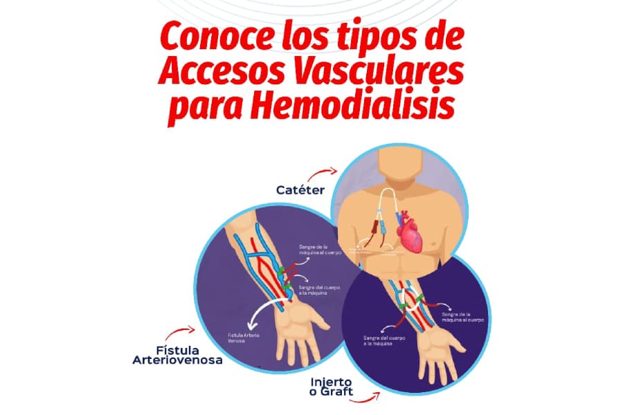Accesos Vasculares para pacientes críticos en UCI.