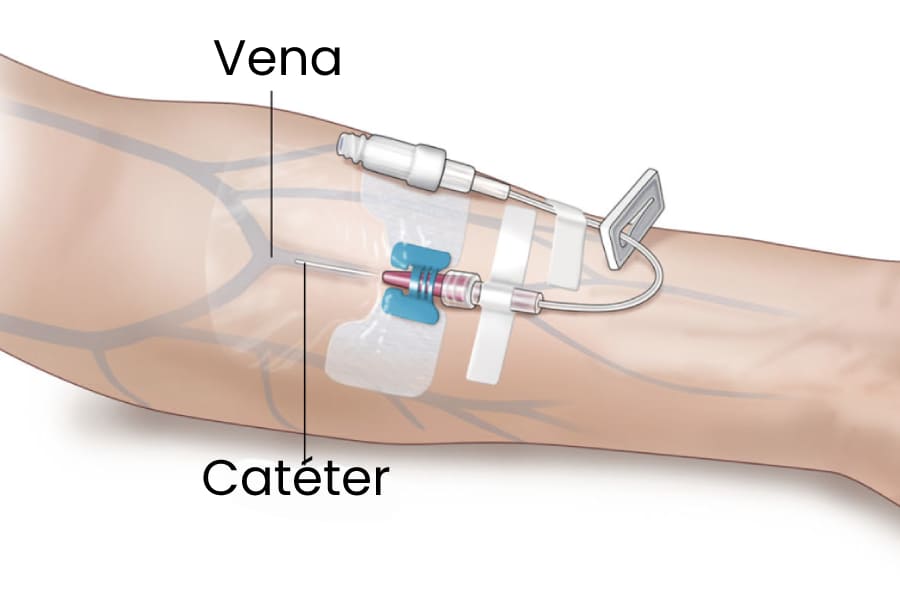 Colocación de catéter para hemodiálisis