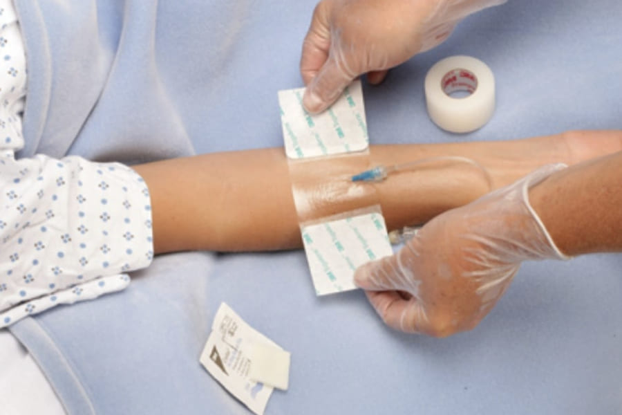 Colocación de catéter para Quimioterapia